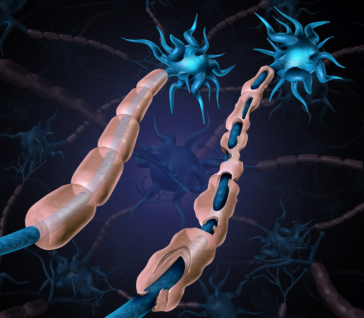 Illustration comparing multiple sclerosis damaged myelin and exposed nerve with un-damaged myelin.